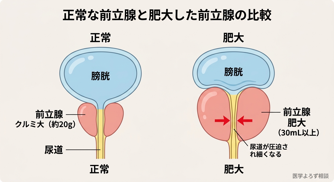 前立腺の解剖——正常と肥大の比較