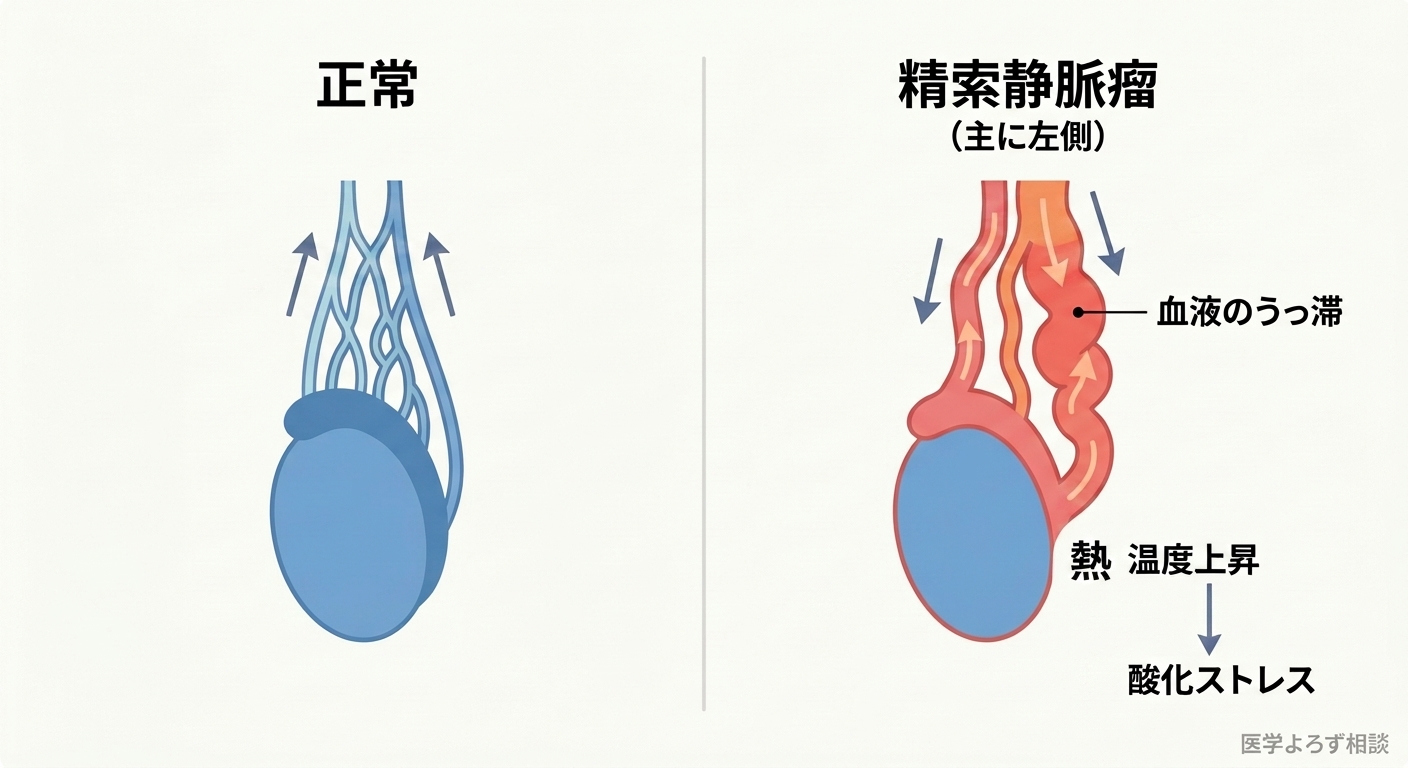 正常な精巣周囲の静脈と、弁の不全で血液がうっ滞してこぶ状になった精索静脈瘤の比較図。うっ滞による温度上昇と酸化ストレスを示す