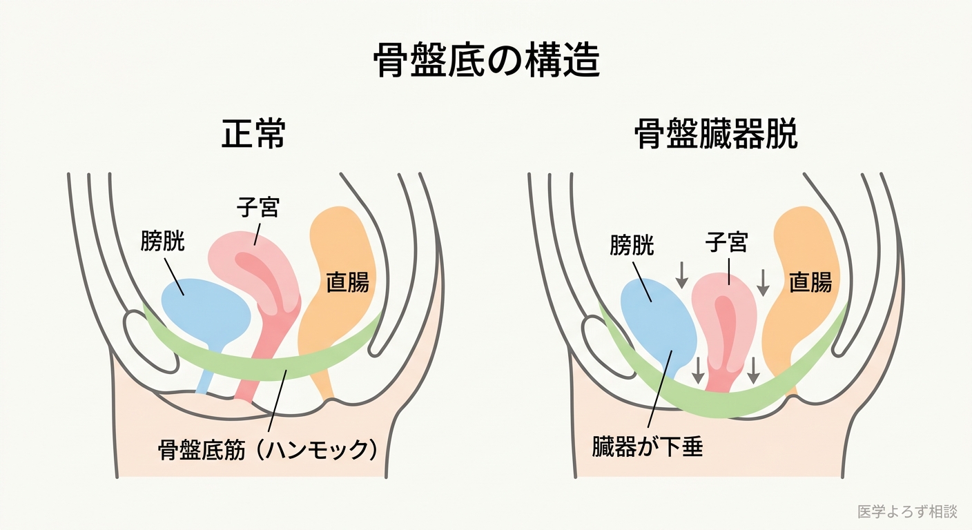 骨盤底の構造の正常と骨盤臓器脱の比較図。左：膀胱・子宮・直腸をハンモック状の骨盤底筋が支える正常な状態。右：骨盤底がゆるみ、膀胱や子宮が腟のほうへ下垂した骨盤臓器脱の状態
