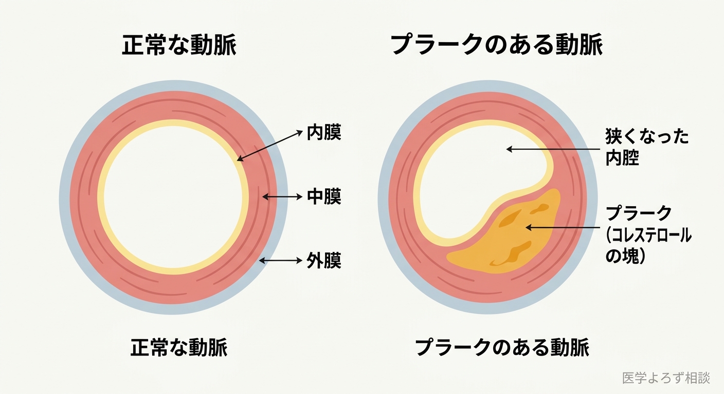 動脈壁の内膜・中膜・外膜の三層構造を示し、正常な動脈とプラークが内膜に蓄積して内腔が狭くなった動脈を左右で対比した図