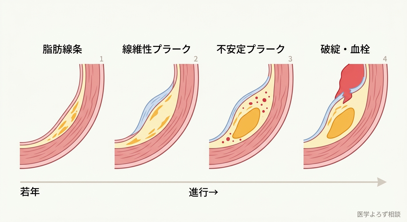 アテローム性プラークが脂肪線条から線維性プラーク、不安定プラーク、破綻・血栓へと進展する4段階を若年から進行へ時間軸で示した図