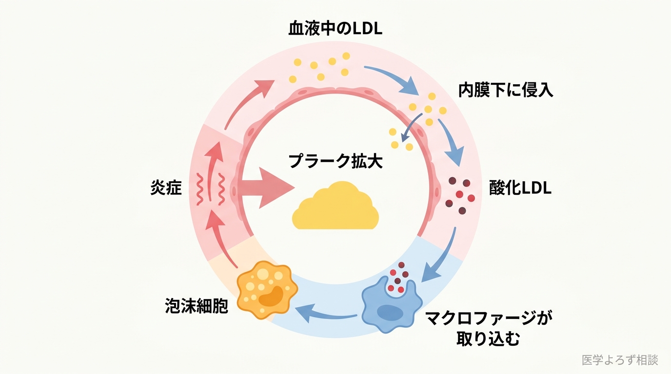 血中LDLが内膜下に侵入して酸化し、マクロファージが取り込んで泡沫細胞となり炎症を起こしてプラークが拡大する機序を循環する矢印で示したフロー図